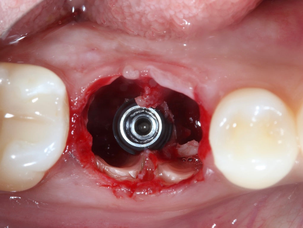 Predictable Implantology 2: Working with Biology