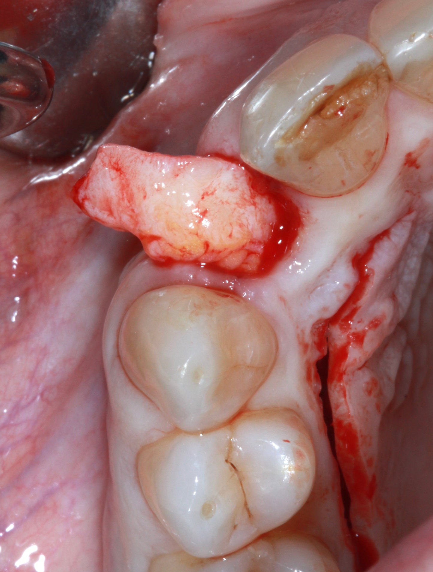 Soft Tissue Immersion