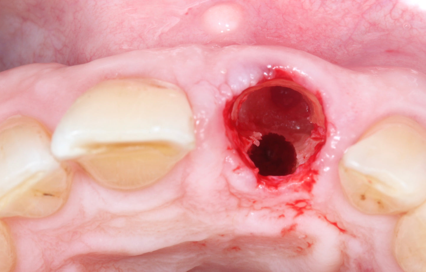 Immediate and Delayed Concepts–Implantology of Esthetic Zone