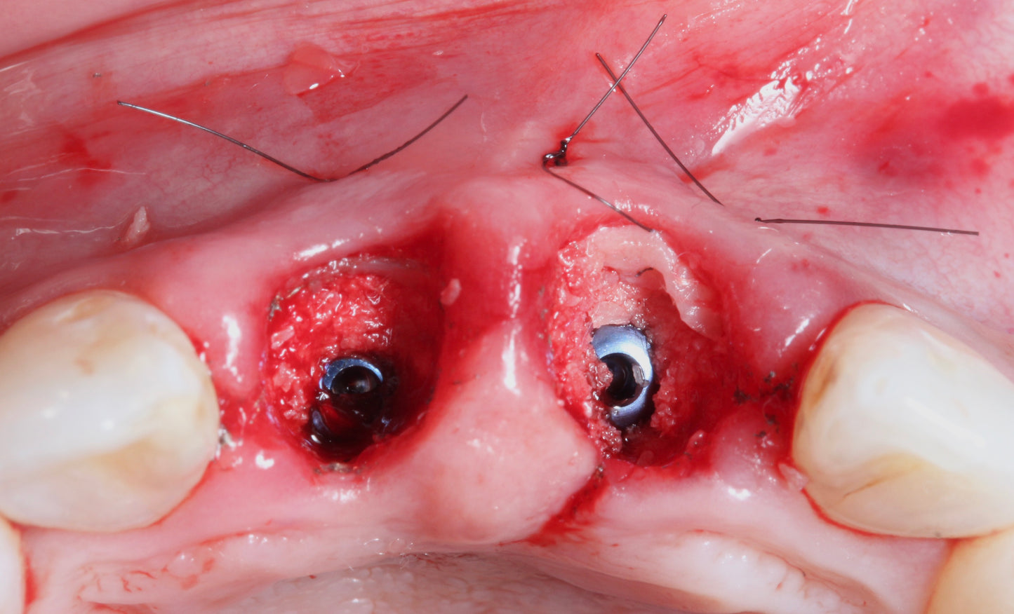 Immediate and Delayed Concepts–Implantology of Esthetic Zone