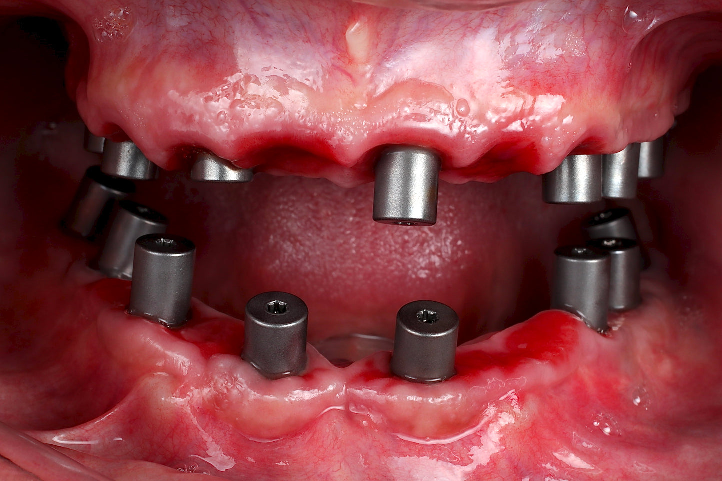 3P's of Partial Extraction Therapy: Preparation, Procedure, and Provisionals