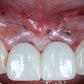 Immediate and Delayed Concepts–Implantology of Esthetic Zone