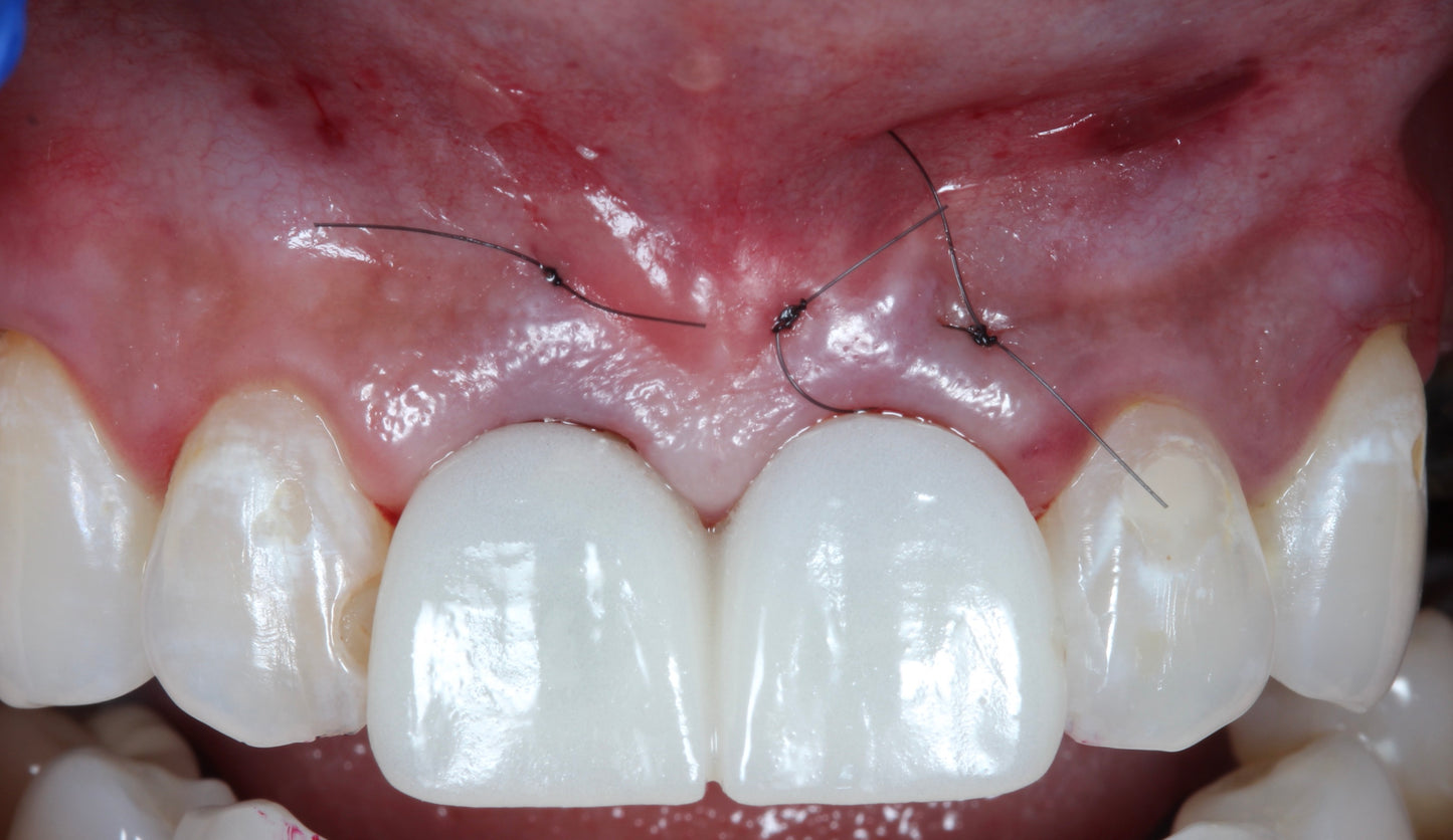 Immediate and Delayed Concepts–Implantology of Esthetic Zone