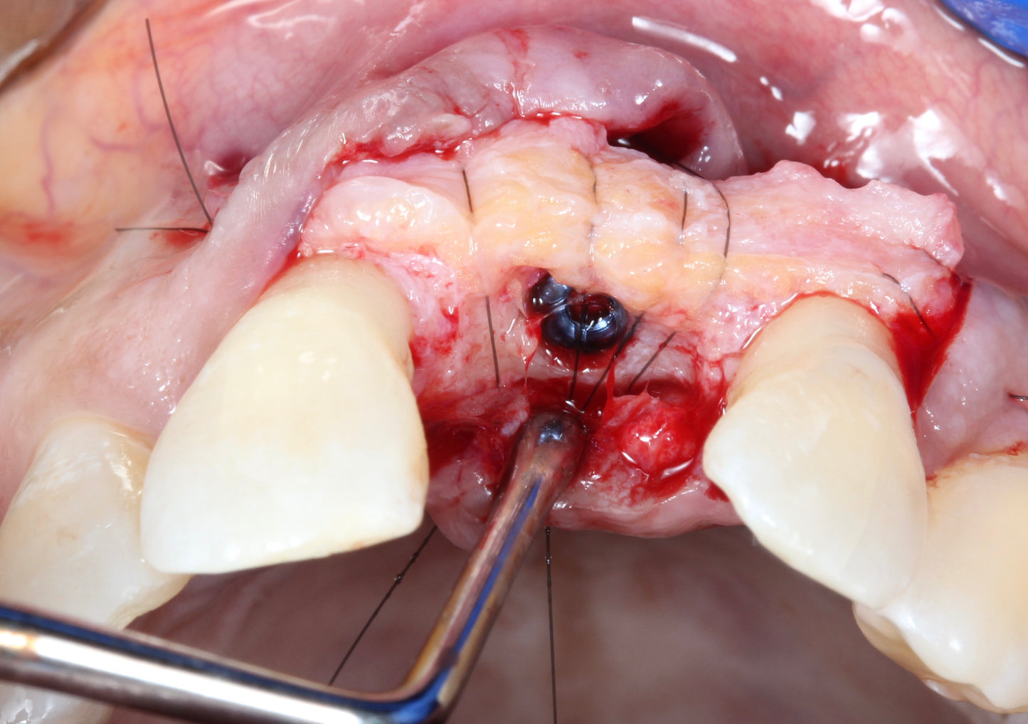 Immediate and Delayed Concepts–Implantology of Esthetic Zone