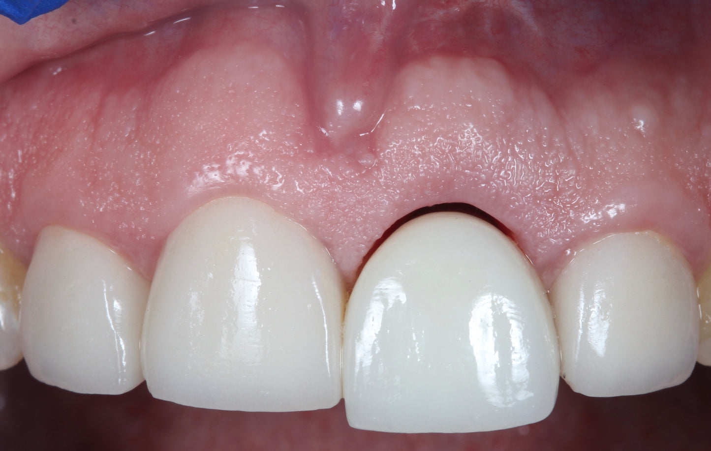 Immediate and Delayed Concepts–Implantology of Esthetic Zone