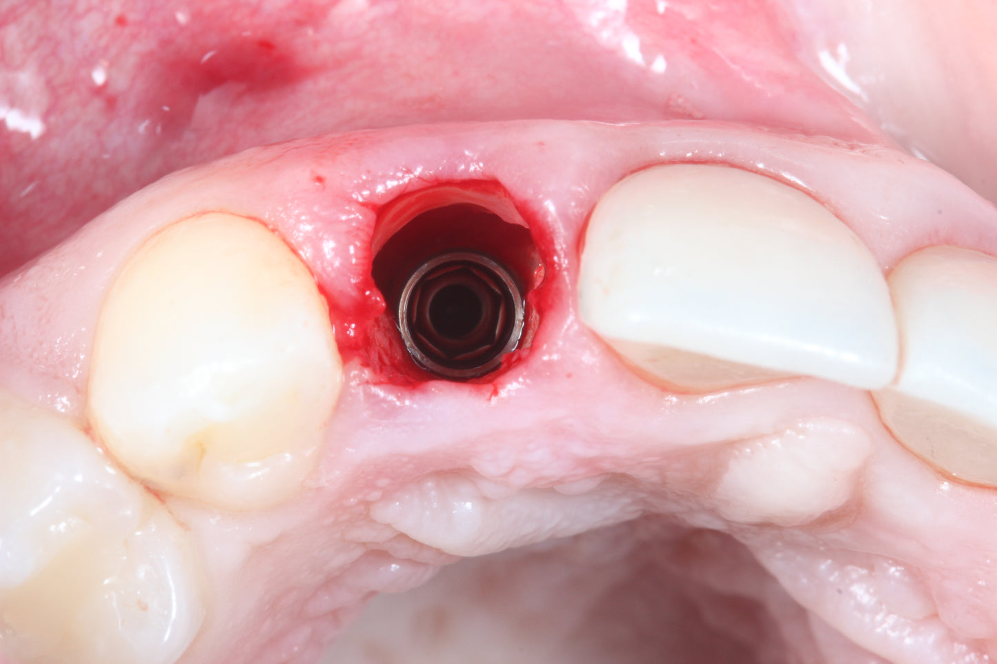 3P's of Partial Extraction Therapy: Preparation, Procedure, and Provisionals