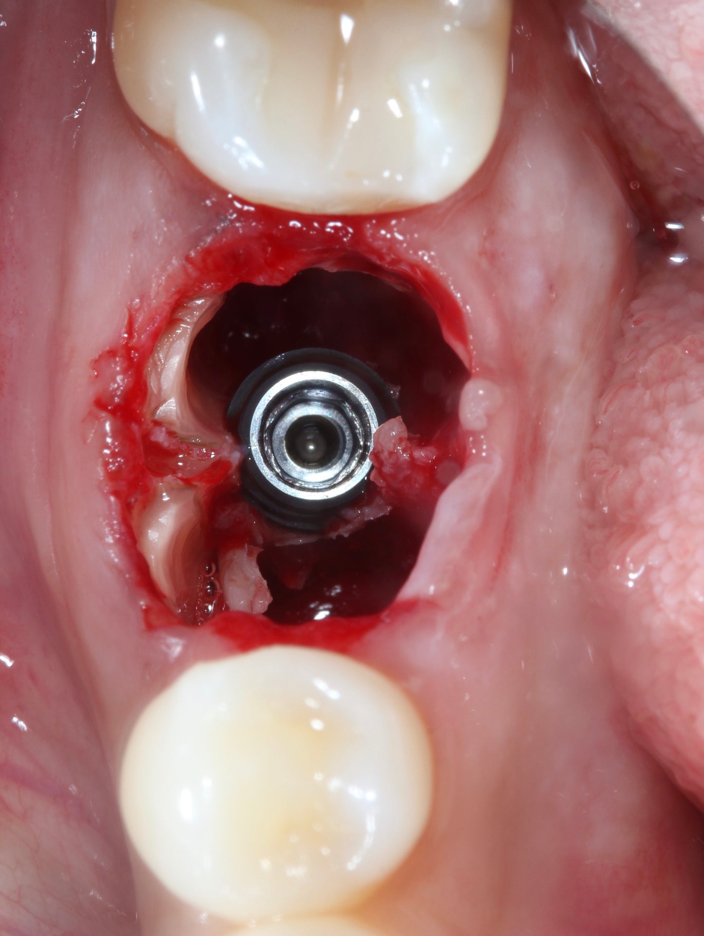 3P's of Partial Extraction Therapy: Preparation, Procedure, and Provisionals